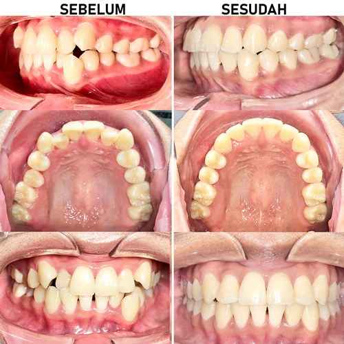 PASANG BEHEL