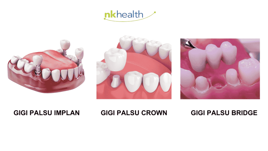 gigi palsu permanen