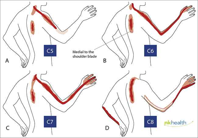 HNP cervical