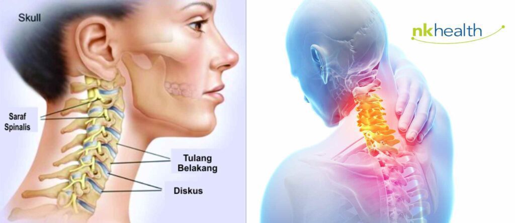 fisioterapi HNP cervical