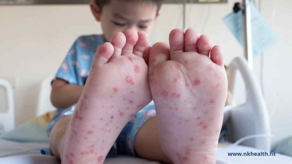 flu singapura anak
