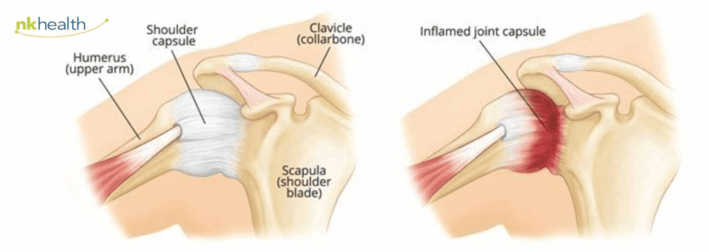 frozen shoulder