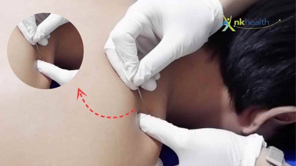 terapi dry needling