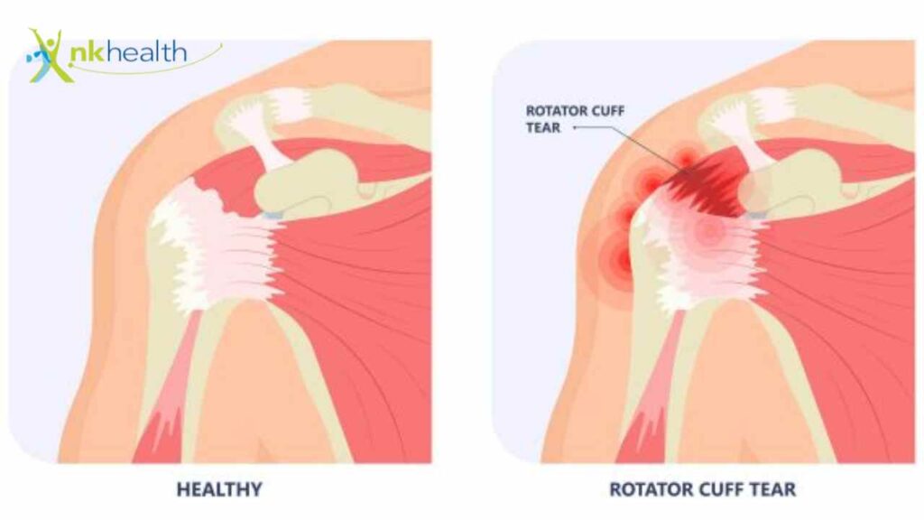 rotator cuff injury