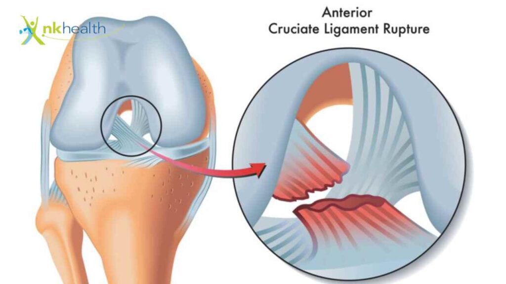 Cedera ACL