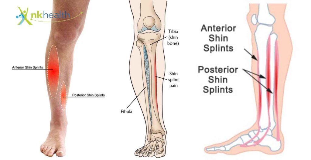 shin splints