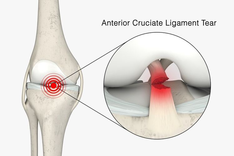Cedera ACL