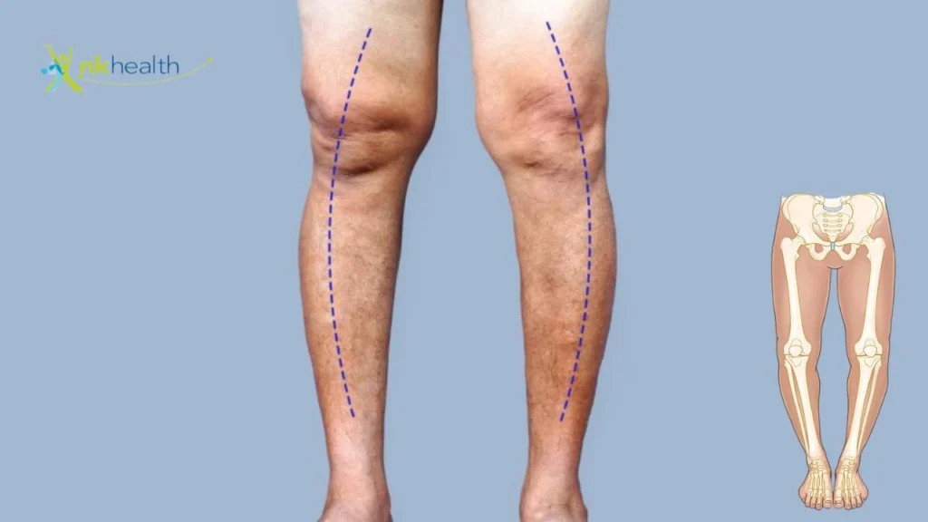Cara Menyembuhkan Kaki O Tanpa Operasi