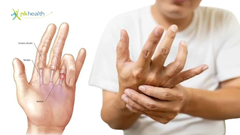 Apakah Trigger Finger Bisa Sembuh Sendiri